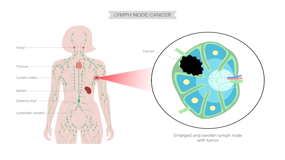 免疫力アップの鍵 、 リンパとカイロプラクティックのつながり
